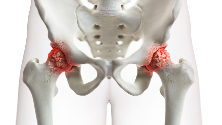 Modello artrosi bilaterale dell'anca
