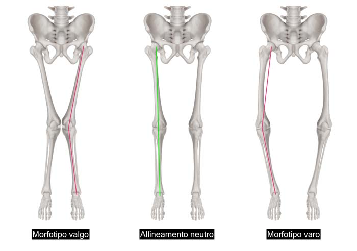 Diversi tipi di allineamento degli arti inferiori