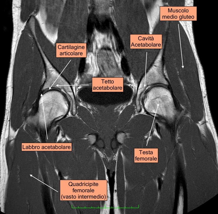 Risonanza Magnetica del bacino: anatomia dell'anca