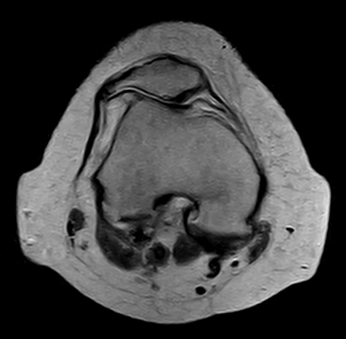 Artrosi femoro-rotulea (immagine RM)