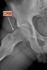 Radiografia assilale dell'anca che mostra conflitto femoro-acetabolare tipo CAM