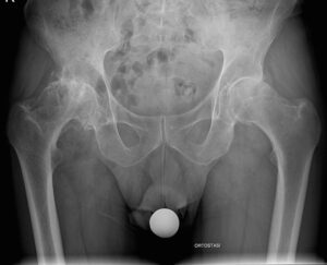 Radiografia del bacino che mostra coxartrosi bilaterale in collo varo
