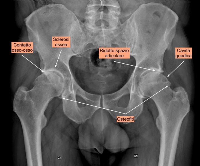 I segni radiografici di artrosi dell'anca