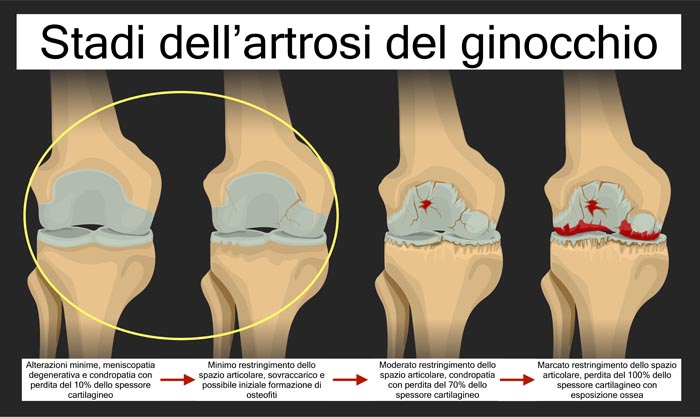 I primi due stadi (evidenziati) rappresentano le alterazioni presenti nell'artrosi iniziale del ginocchio