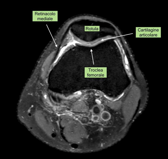 Anatomia dell'articolazione femore-rotulea (immagine RM)