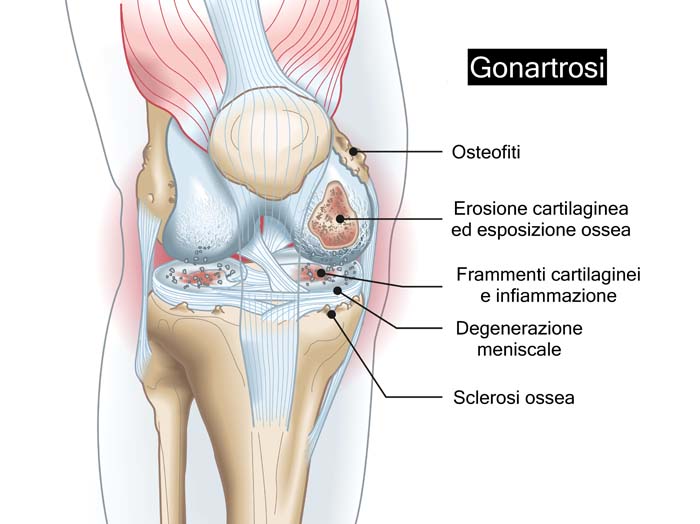 Artrosi del ginocchio: le alterazioni responsabili della sintomatologia dolorosa