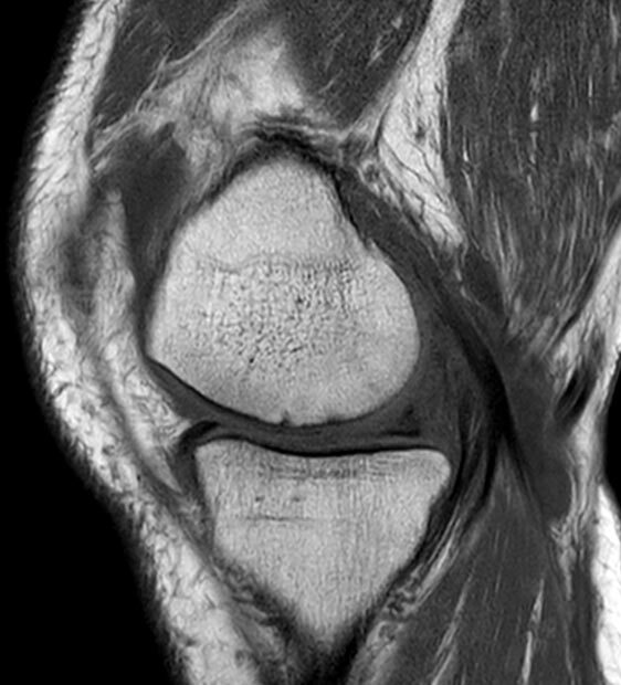 Artrosi iniziale del compartimento mediale: quadro RM