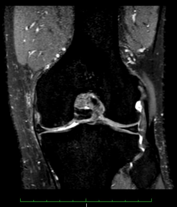 Artrosi iniziale del ginocchio con interessamento cartilagineo e meniscale del compartimento interno