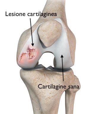 Lesione cartilaginea del ginocchio