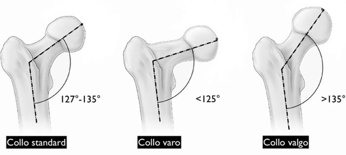 Morfologia del collo femorale