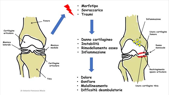 Illustrazione schematica della genesi del danno articolare nella gonartrosi
