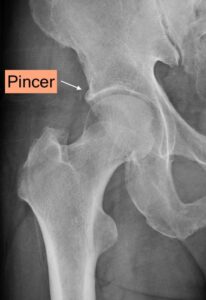 Radiografia dell'anca destra che mostra conflitto femoro-acetabolare tipo Pincer