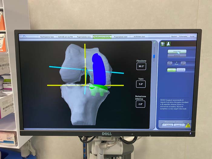 Le immagini TAC vengono rielaborate da un software in grado di creare un modello 3D dell'anatomia specifica del paziente, con questo è possibile creare un piano pre-operatorio personalizzato