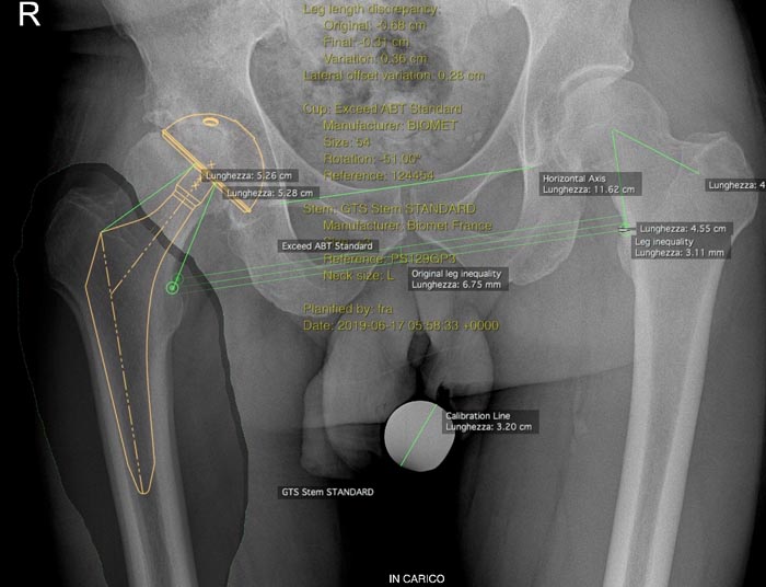 Planning radiografico digitale per intervento di protesi totale d'anca a destra