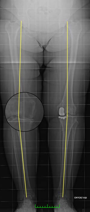 Ripristino dell'asse dell'arto inferiore dopo intervento chirurgico di protesi monocompartimentale