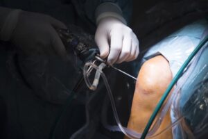 Artroscopia del ginocchio