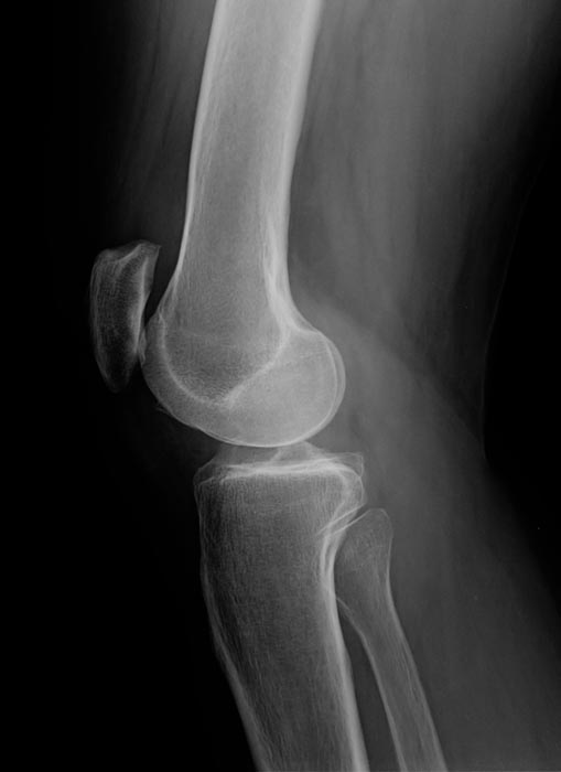 Artrosi femoro-rotulea: la rotula alta rappresenta una delle principali alterazioni morfologiche implicate  nello sviluppo di danno cartilagineo