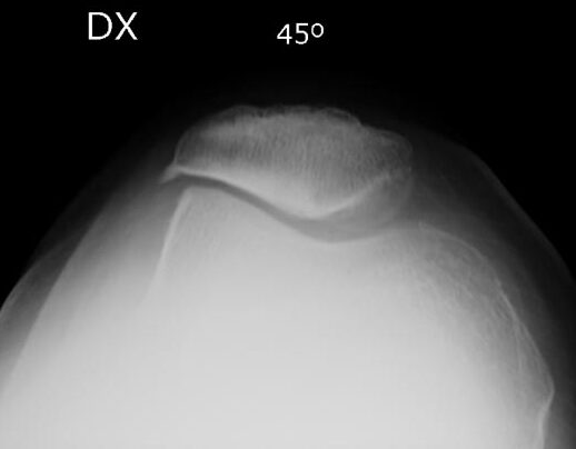 Artrosi femoro-rotulea: la radiografia assiale del ginocchio fornisce molte informazioni sull'origine della patologia