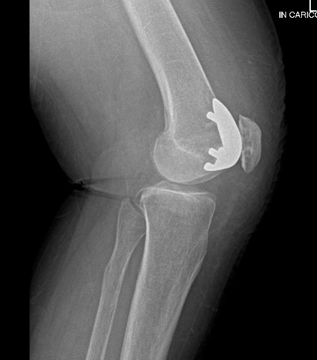 Protesi femoro-rotulea: radiografia laterale del ginocchio