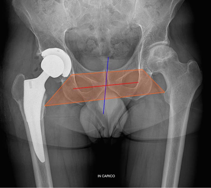 Protesi dell'anca, caso clinico 1