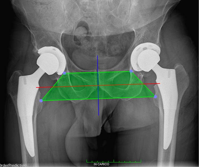 Protesi dell'anca, caso clinico 1.2