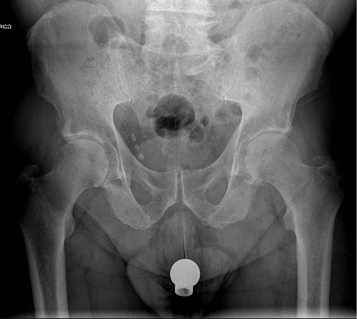 Protesi dell'anca, caso clinico 2