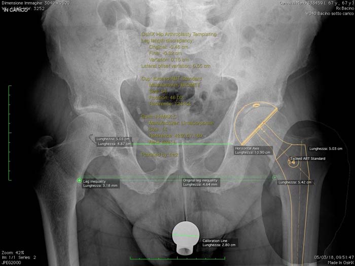Protesi dell'anca, caso clinico 2.2