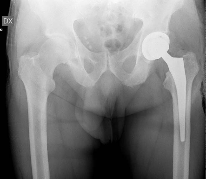 Protesi dell'anca, caso clinico 2.3