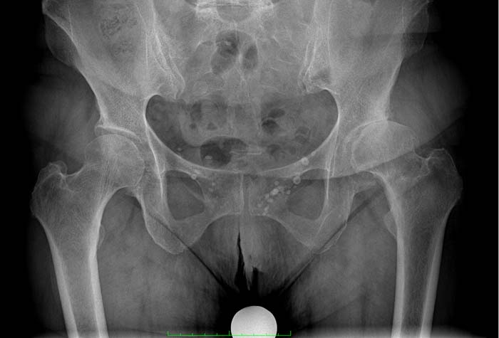 Protesi dell'anca, caso clinico 3