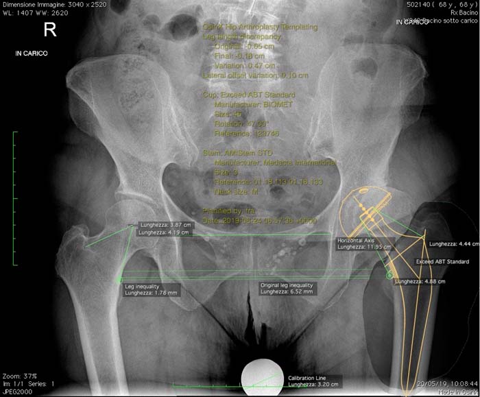 Protesi dell'anca, caso clinico 3.2