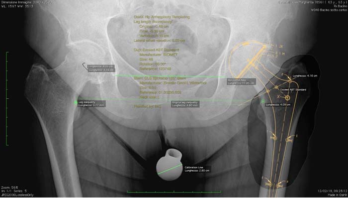 Protesi dell'anca, caso clinico 4.2