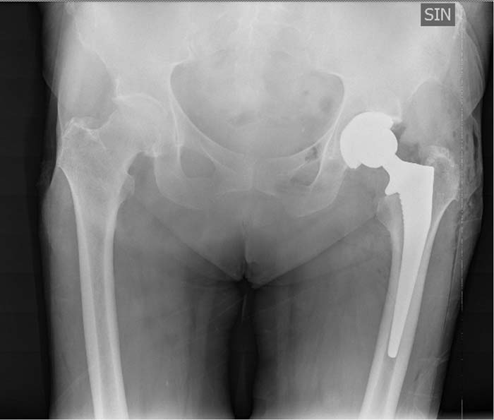 Protesi dell'anca, caso clinico 4.3