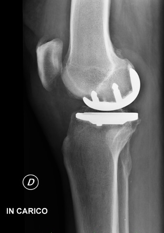 Protesi ginocchio, caso clinico 1