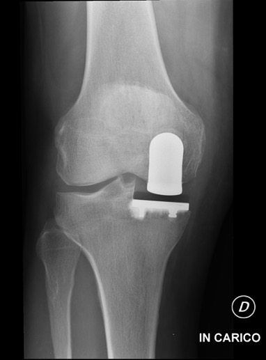 Protesi ginocchio, caso clinico 1.4