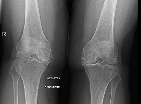 Protesi ginocchio, caso clinico 2