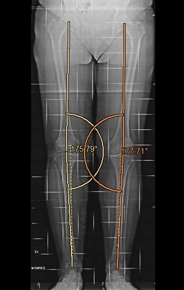 Ginocchio varo bilaterale e artrosi del compartimento mediale (teleradiografia), caso clinico 2