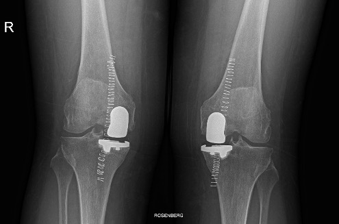 Protesi ginocchio, caso clinico 2.3