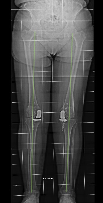 Protesi ginocchio, caso clinico 2.4