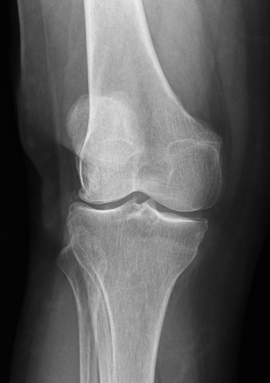 Protesi ginocchio, caso clinico 3