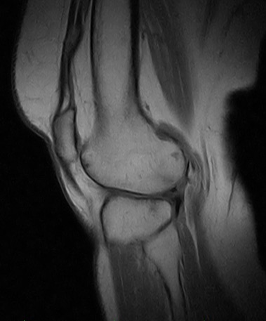 Protesi ginocchio, caso clinico 3.2