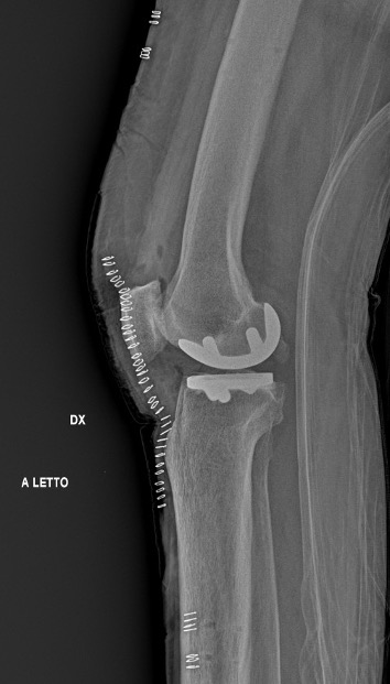 Protesi ginocchio, caso clinico 3.4