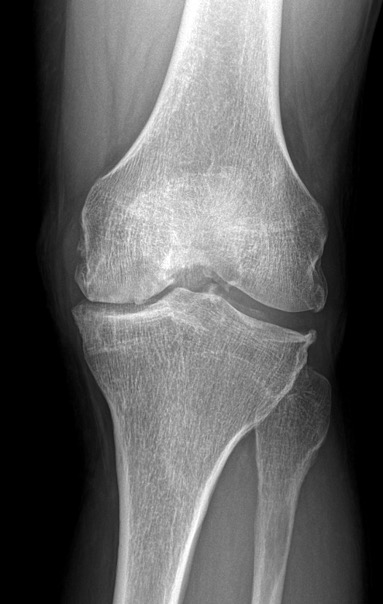 Protesi totale ginocchio, caso clinico 1.2