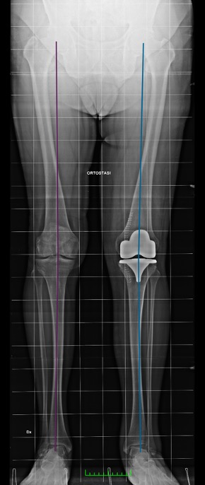 Teleradiografia degli arti inferiori: controllo post-operatorio dell'allineamento in protesi totale ginocchio sinistro , caso clinico 1