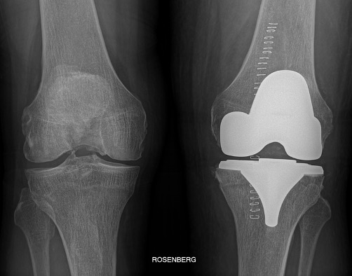 Protesi totale del ginocchio sinistro, caso clinico 1 (radiografia AP)