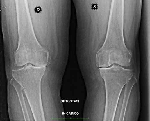 Protesi totale ginocchio, caso clinico 2.1