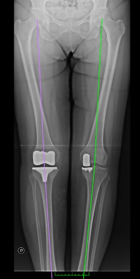 Protesi totale ginocchio destro e protesi monocompartimentale ginocchio sinistro, teleradiografia degli arti