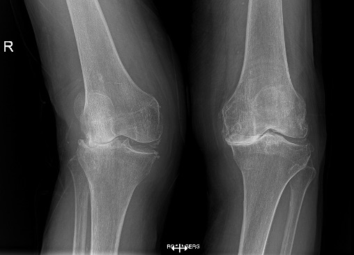 Protesi totale ginocchio, caso clinico 3