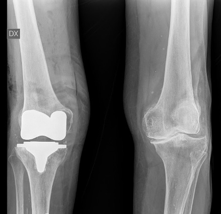 Protesi totale ginocchio, caso clinico 3.3