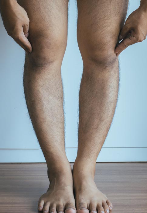 Allineamento degli arti inferiori: ginocchio varo