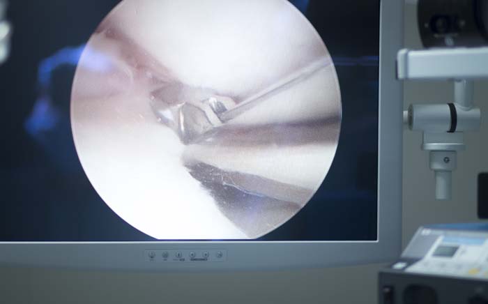 Artroscopia del ginocchio: intervento di meniscectomia